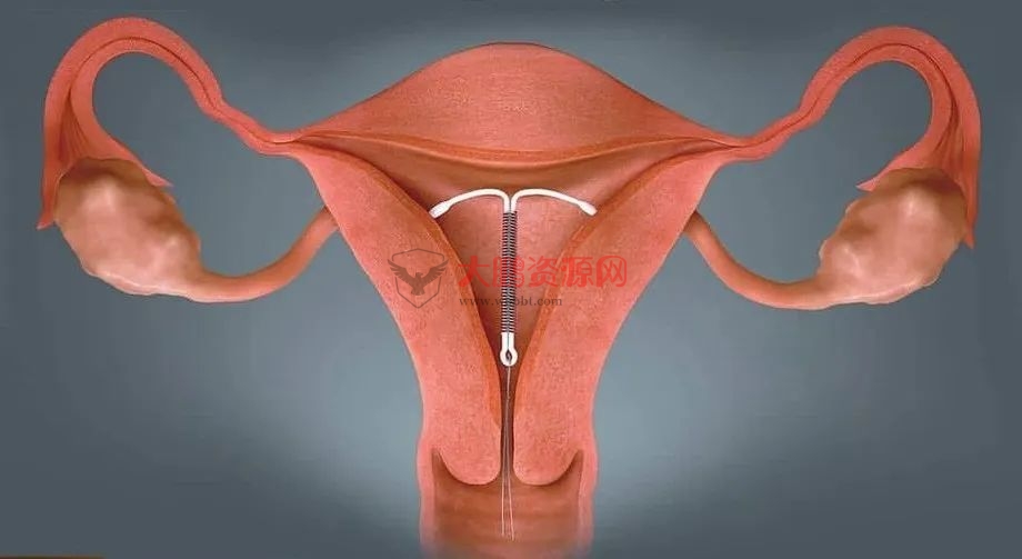 避孕不止安全套，17种避孕方法了解一下好兄弟们插图3